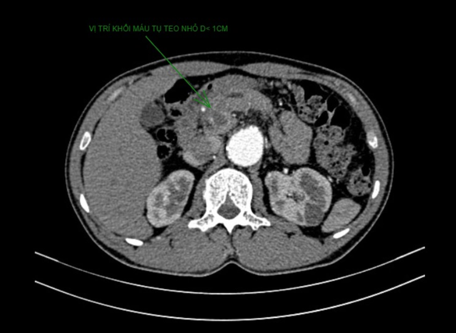 Hình CT cho thấy khối máu tụ của người bệnh teo nhỏ sau can thiệp.jpg